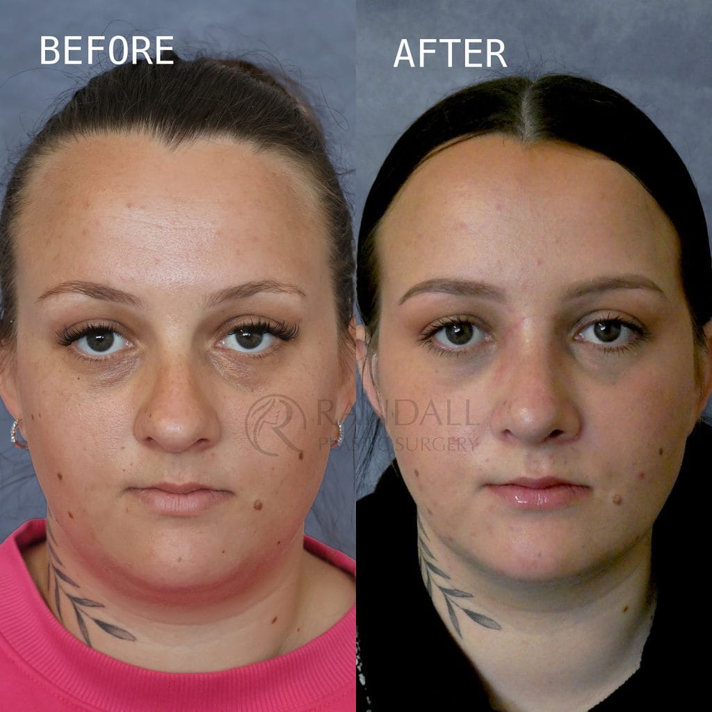 before and after rhinoplasty showing refinement of a bulbous tip