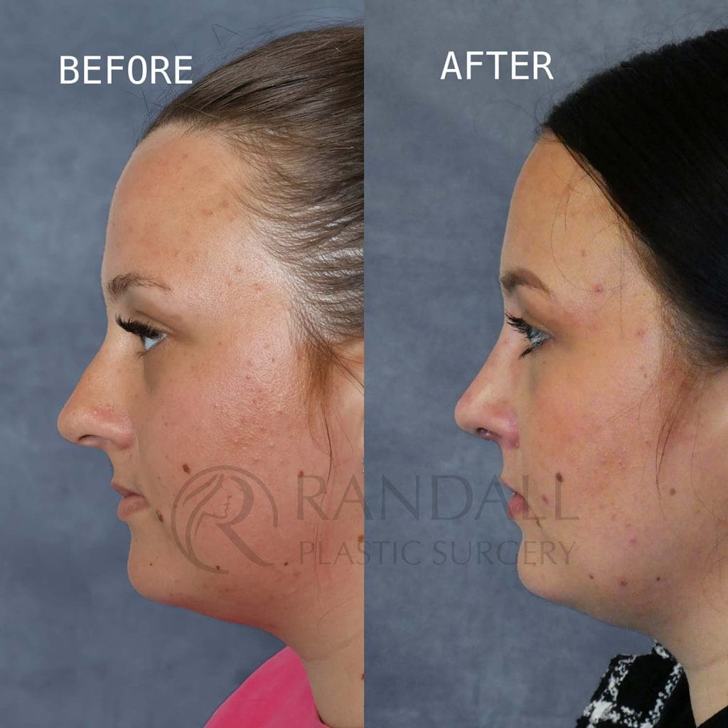 before and after rhinoplasty showing dorsal hump reduction and rotation of the profile