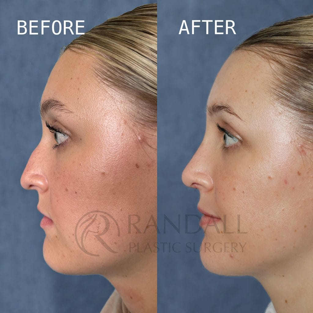 before and after rhinoplasty showing dorsal hump reduction, better projection and rotation