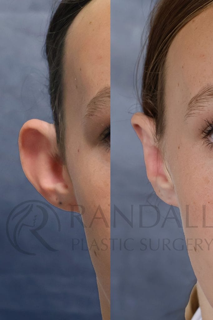 A before and after picture of otoplasty by Dr. Randall in Morristown, NJ