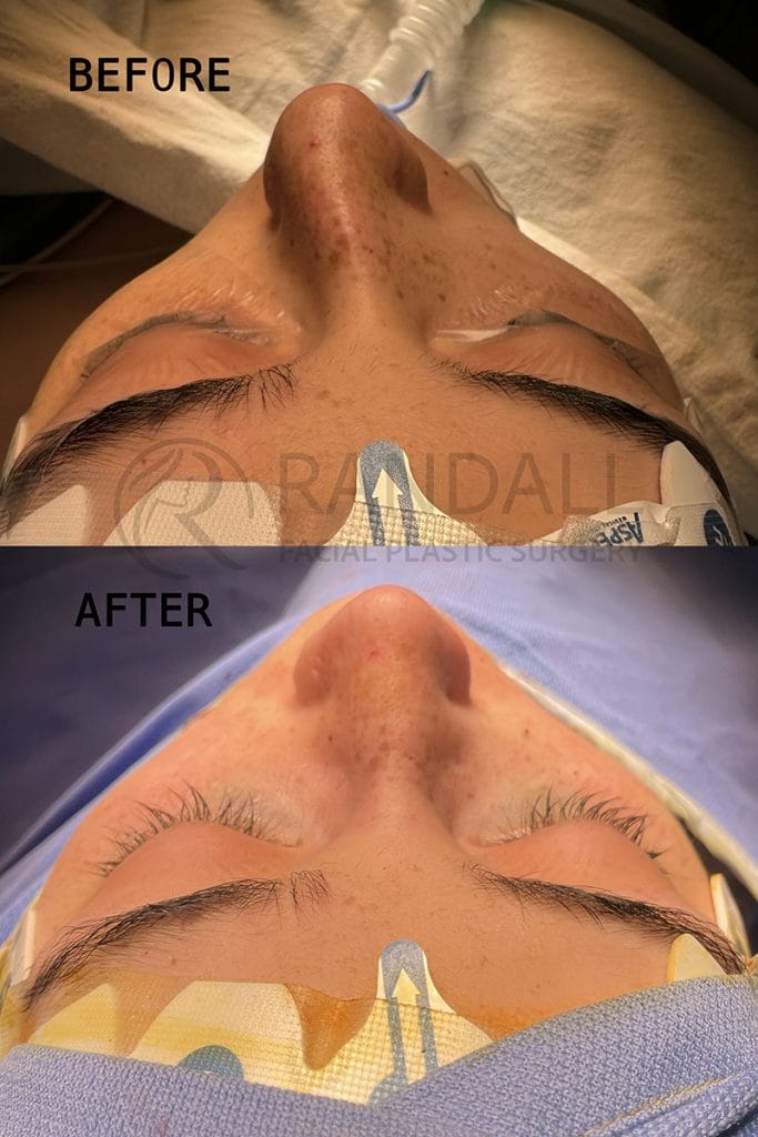 Before and after straightening a crooked nose due to crooked septum- the ideal result from an open septorhinoplasty or septoplasty with Dr. Randall in Morristown, NJ